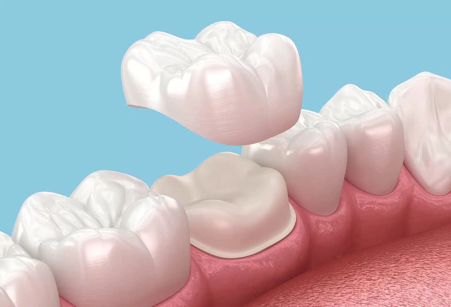 Dental Crown